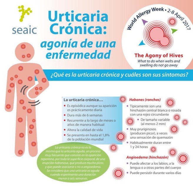 Urticaria cronica